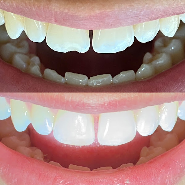 Foto 2 de Implantes Dentários - Dr. Victor Petrin - Dentista