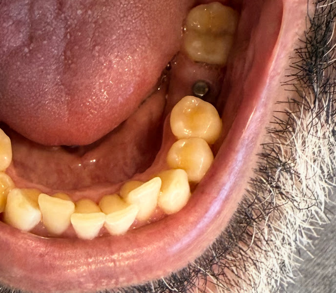 Foto 3 de Implantes Dentários Itaquera - Dr. Jefferson Oestmann