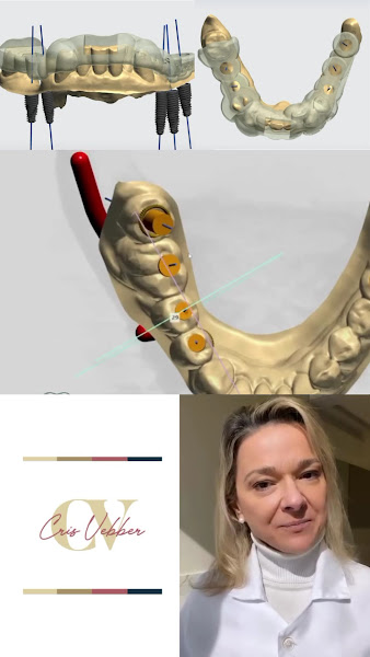 Foto 3 de Implantes Dentários/ Proteses Dentárias/ Estética- Dra. Cristine Isabel Vebber odontologia, Dentista