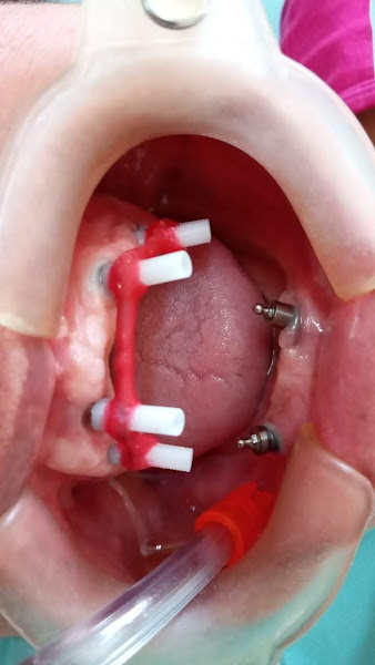 Foto 3 de Implantes Jabaquara