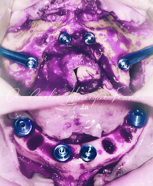 Foto 2 de Implantes Zigomáticos - Casos extremos - reabilitação de maxilares atróficos - protocolos complexos de retratamento