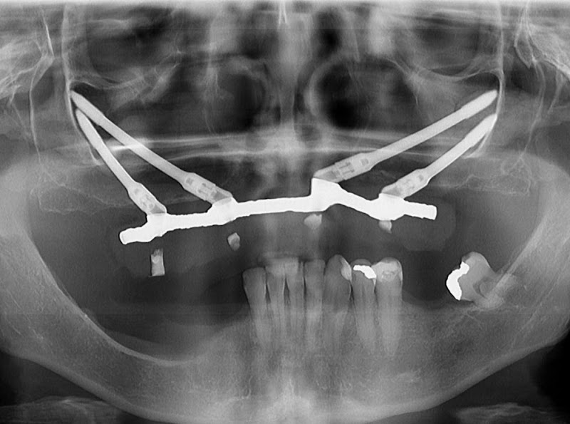 Foto 3 de Implantes Zigomáticos - Casos extremos - reabilitação de maxilares atróficos - protocolos complexos de retratamento