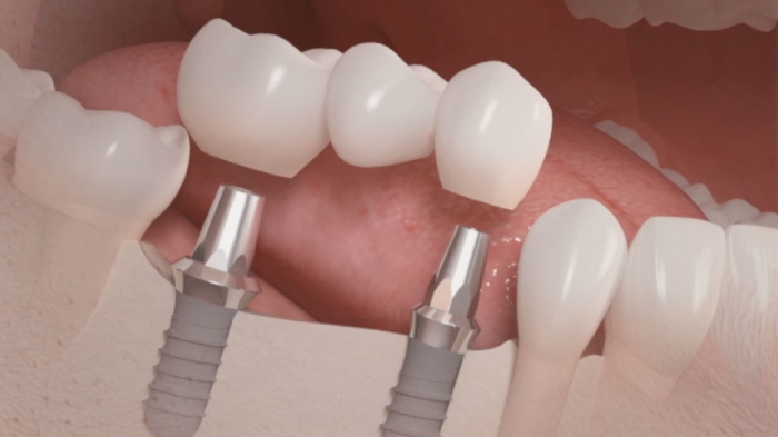 Foto 2 de ImplantEXS - Eduardo Xavier - Dentista