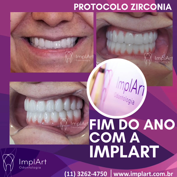Foto 2 de ImplArt Odontologia Implante Dentario