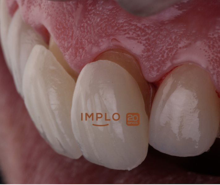 Foto 3 de IMPLO