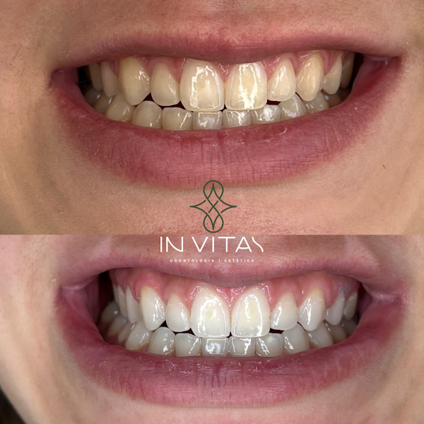 Foto 2 de In Vitas | Dentista Chácara Santo Antônio | Estética | SouSmile | Harmonização facial | Clareamento dental