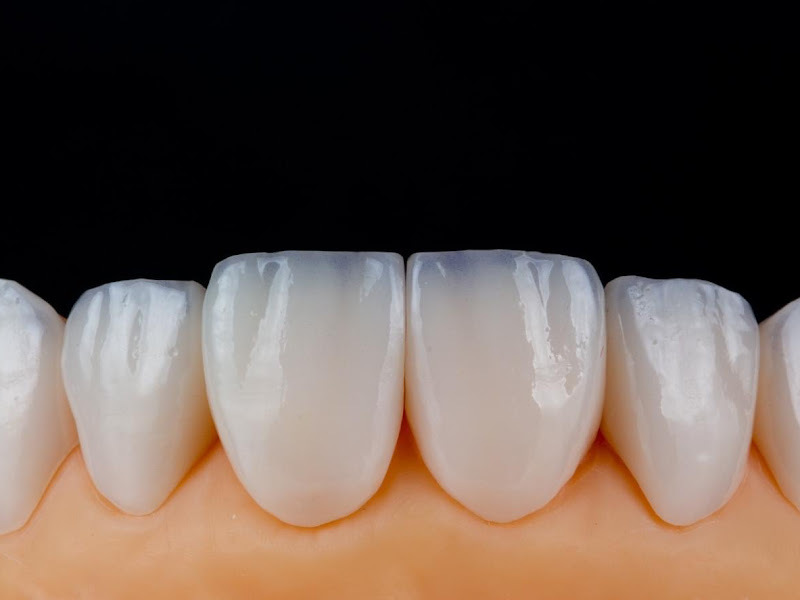 Foto 11 de Innova - Instituto Avançado de Odontologia - Implante dentário- Prótese Protocolo - Prótese Fixa - Odontologia Digital