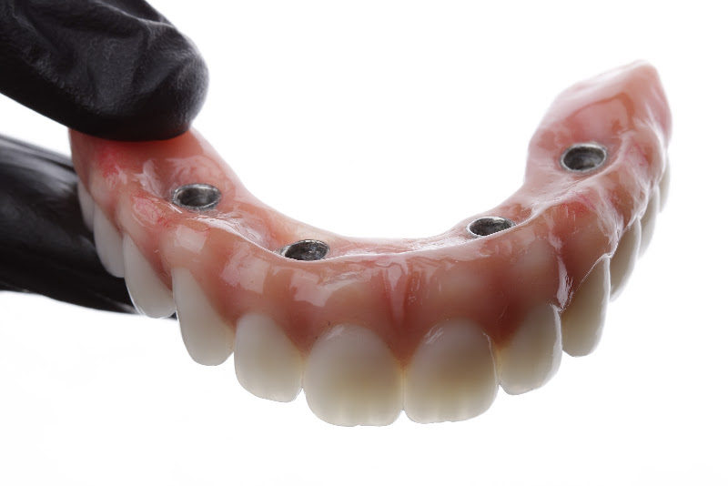 Foto 2 de Inove Odontologia e Estética - Dentista em Garanhuns - Implante e Prótese