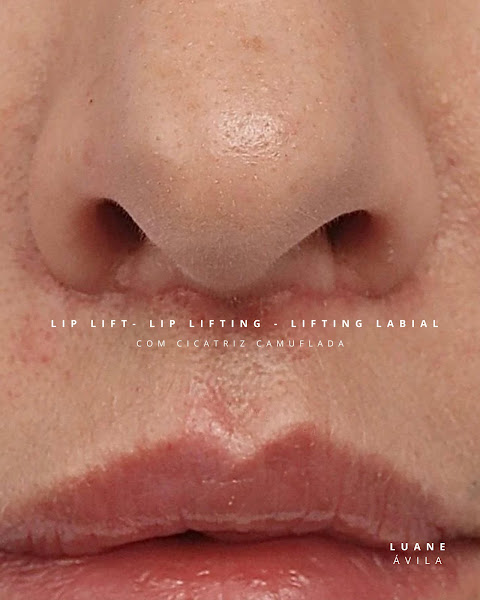 Foto 3 de Instituto Bucomaxilo - Lip lift e Rinomodelação definitiva em Salvador