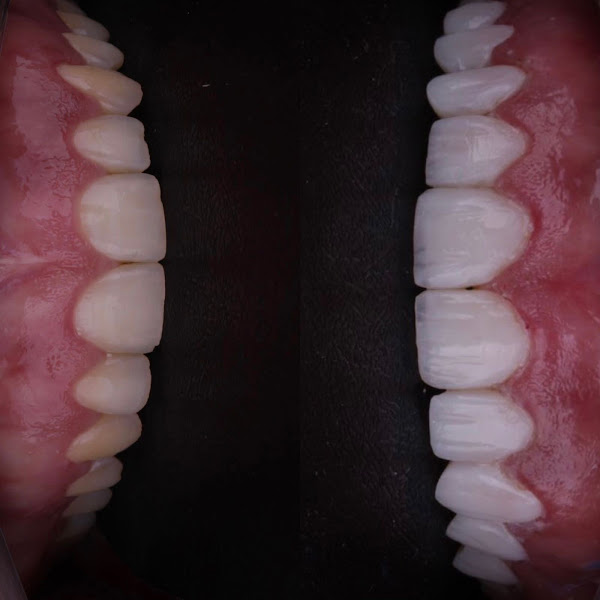 Foto 3 de Instituto Mariana Almeida - Sorocaba - Lentes em Resina l Prótese Dentária l Lente de Contato Dental l Dentista Sorocaba