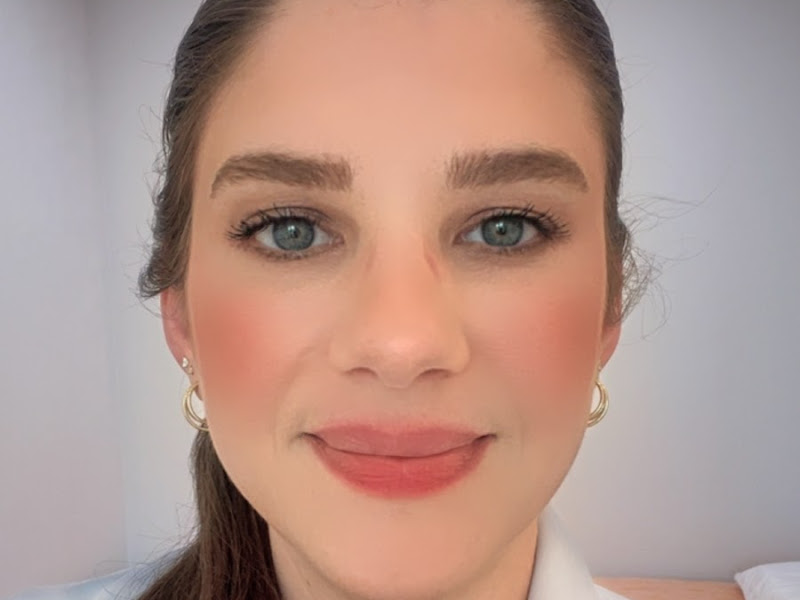 Foto 5 de Invisalign em Caxias do Sul - Lentes de Contato Dental - Dr. Bruno Cerci - Dental Vitta