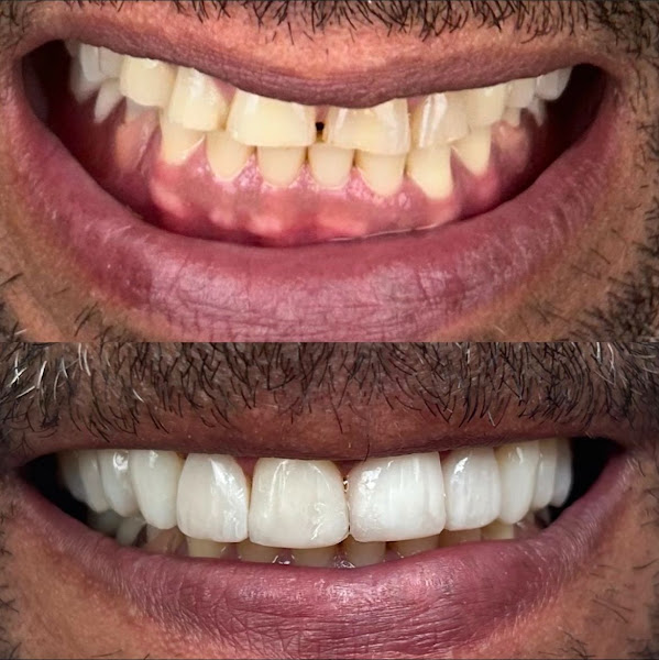 Foto 3 de INVISALIGN SAVASSI- AG Odontologia Avançada- Dra Glauce Freitas