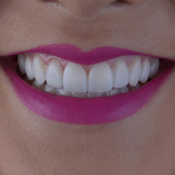 Foto 2 de IOP - Ortoestética Lagoa Nova: Implante dentário, Clareamento Dental, Dentista, Natal RN