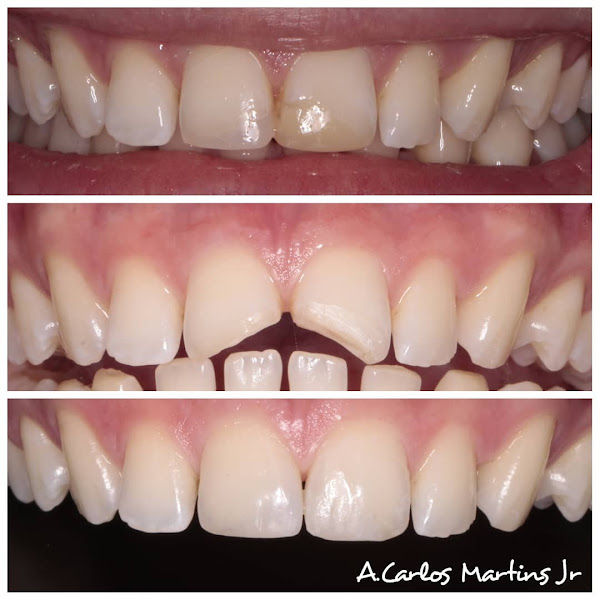 Foto 3 de IOP - Ortoestética Lagoa Nova: Implante dentário, Clareamento Dental, Dentista, Natal RN