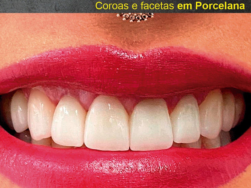 Foto 3 de JBM Odontologia e Saúde | Dentista Santo Andre - Jardim| Endodontia - Invisalign - Implante Dentario - Faceta