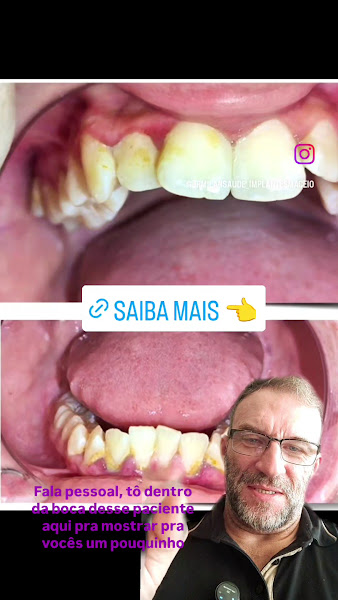 Foto 4 de João Ricardo Tamarozzi Milan - Periodontista e Implantodontia em Maceió - JRMilan Saúde - IG: @jrmilansaude_implantesmaceio