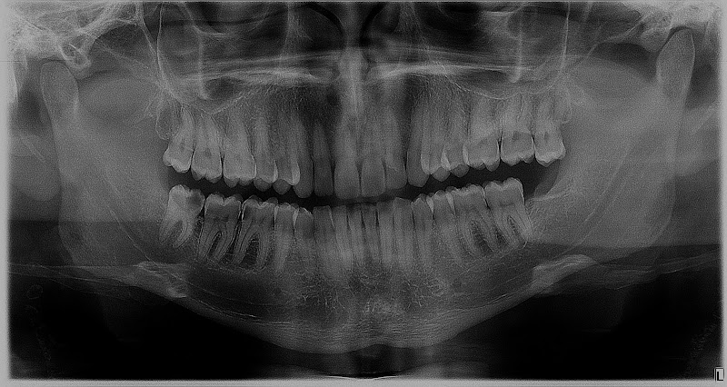 Foto 2 de JOGI Odontologia - Próteses Dentárias - Implantes - Facetas em resina - Odontopediatria em Pirituba