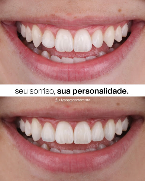 Foto 3 de Julyana Gois Odontologia - Lentes de Resina em Curitiba | Dentista no Batel