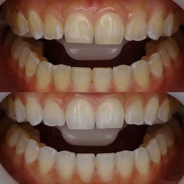 Foto 3 de Karina Macêdo Odontologia | Invisalign e Estética em Resina