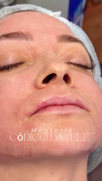 Foto 3 de Keila Dâmaso - Harmonização Facial