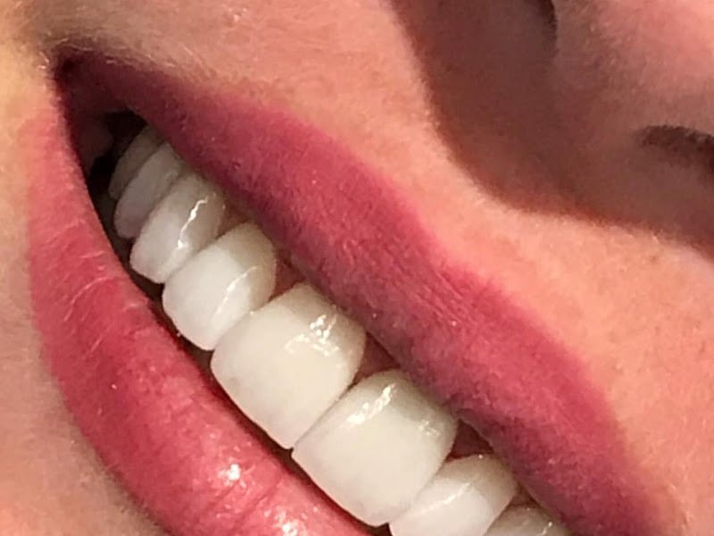 Foto de Lente de Contato Dental em Recife