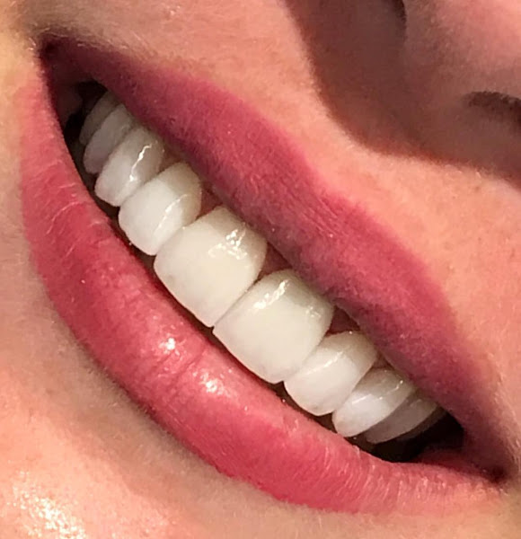 Foto 2 de Lente de Contato Dental em Recife