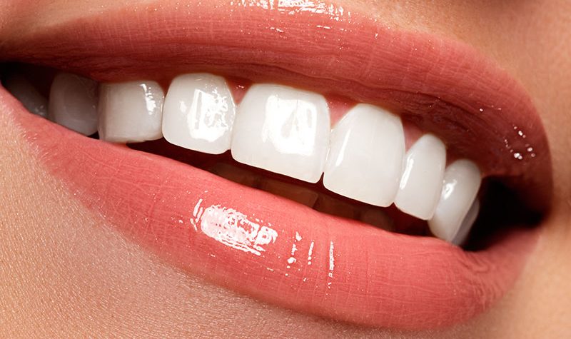 Foto 3 de Lente de Contato Dental em Recife