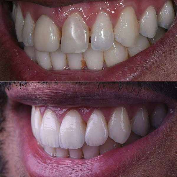 Foto 4 de Lente de Contato Dental em Recife