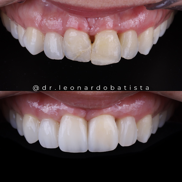 Foto 3 de Lentes de Contato Dental São Luís MA - T&L Odontologia