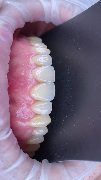 Foto 4 de Lentes de Contato Dental São Luís MA - T&L Odontologia