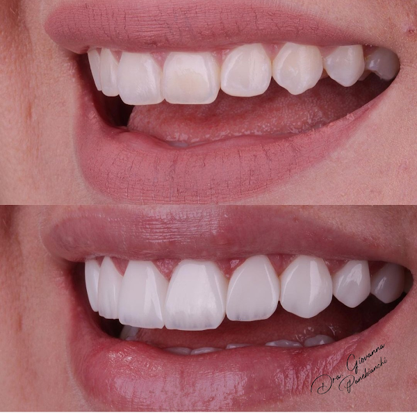 Foto 2 de Lentes de Resina em Marília - Dra. Giovanna Panebianchi