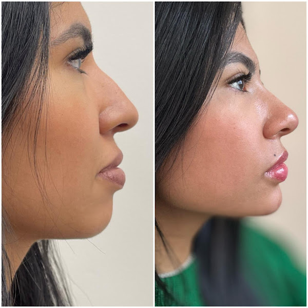 Foto 3 de Leticia Kraide - HARMONIZAÇÃO FACIAL