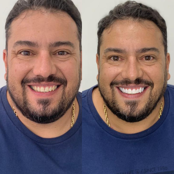 Foto 3 de Líder Odontologia - Campo Grande, Implantes dentários, Próteses, Alinhadores