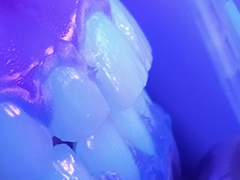 Foto de LineUp Smile - Unidade São Bernardo do Campo - Especializada tratamentos ortodônticos com alinhadores