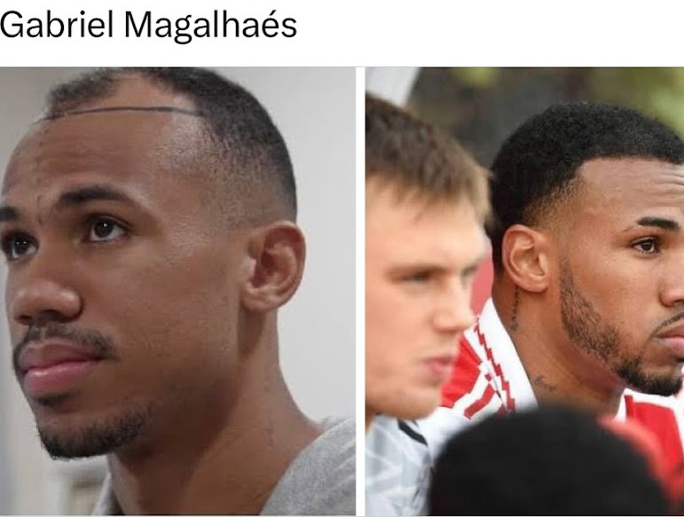 Foto 3 de Lion Hair Transplant - Transplante e Implante Capilar em Anápolis | Tratamentos para Calvície | Medicina Capilar