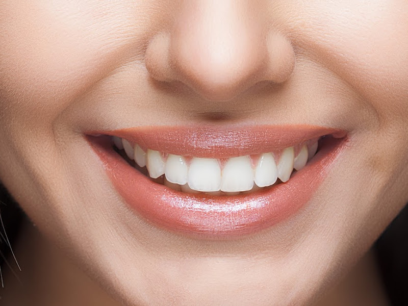 Foto de Lipo de Papada BH | Prótese Dentária Fixa BH | Dentista BH | Bichectomia BH | Dra. Carolina Macedo