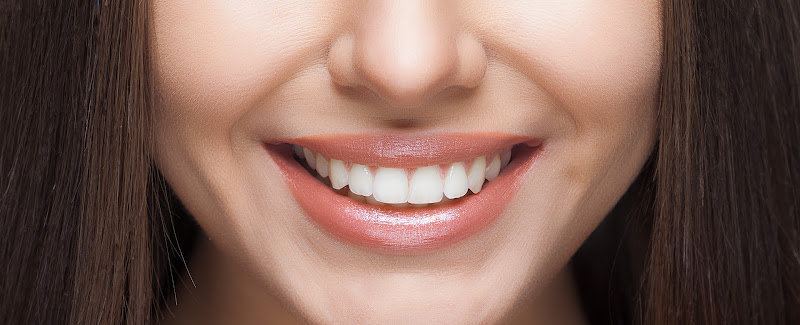 Foto 2 de Lipo de Papada BH | Prótese Dentária Fixa BH | Dentista BH | Bichectomia BH | Dra. Carolina Macedo