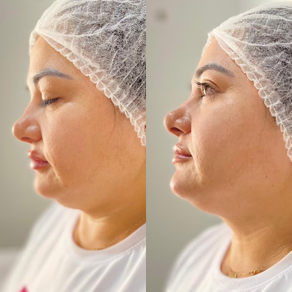 Foto 2 de LôAlves - Harmonização Facial e Corporal | Parauapebas