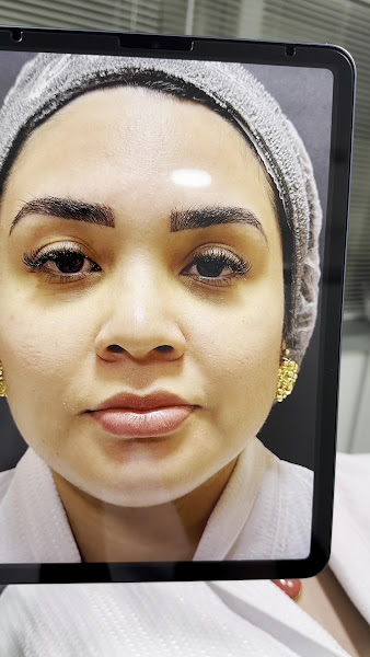 Foto 3 de Lorrane Rabelo | Harmonização Facial em Manaus