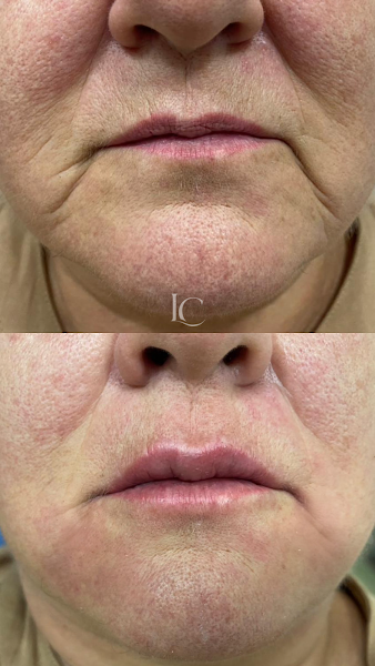 Foto 3 de Luiza Caressato | Odontologia Estética e Harmonização Facial