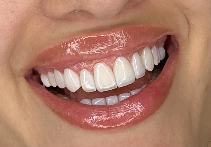 Foto 3 de Lux Estética Odontológica - Referência em Facetas em Resina - Alphaville