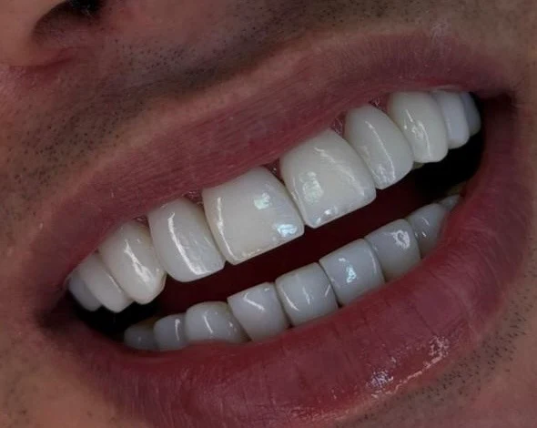 Foto 3 de Lux Estética Odontológica - Referência em Facetas em Resina - São Bernardo do Campo