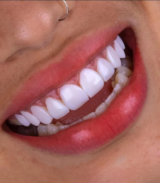 Foto 2 de Lux Estética Odontológica - Referência em Facetas em Resina - São José dos Campos