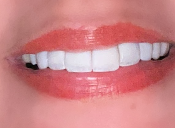 Foto 3 de Lux Estética Odontológica Santos - Referência em Facetas em Resina