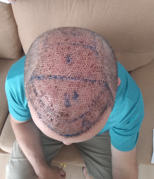Foto 3 de Mansur Transplante Capilar