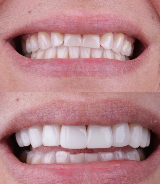 Foto 3 de Maraína Bruniera Dentista Ribeirão Preto - Facetas de Resina | Implantes Dentários | Clareamento Dental e Ortodontia