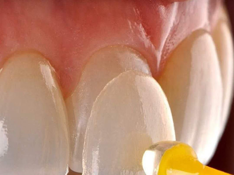 Foto 9 de MAVI Consultório Odontológico | Clareamento | Facetas | Implantes | Aparelhos Ortodônticos | Passo Fundo