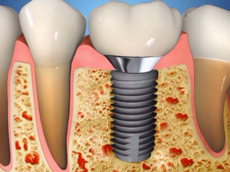 Foto 7 de Maxsorriso Implantes Dentários | Goiânia - GO