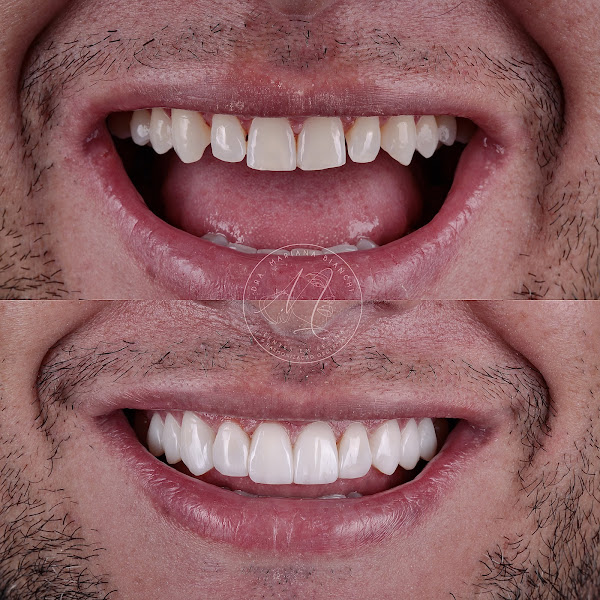 Foto 2 de MB Clinic | Dra. Mariana Bianchi - DENTISTA INDAIATUBA E JUNDIAÍ - LENTES EM RESINA - HARMONIZAÇÃO OROFACIAL