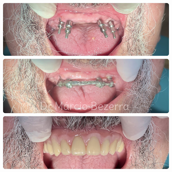Foto 3 de MB Odontologia - Dr Márcio Bezerra - Implante Dentário em Belém